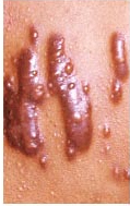 keloid scarring