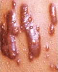 keloid scarring
