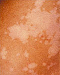 Shifting Clouds, Lhotha or Tinea Versicolor
