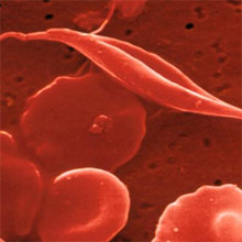 sickle cell